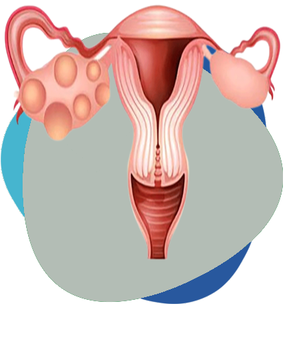 Ovary Syndrome